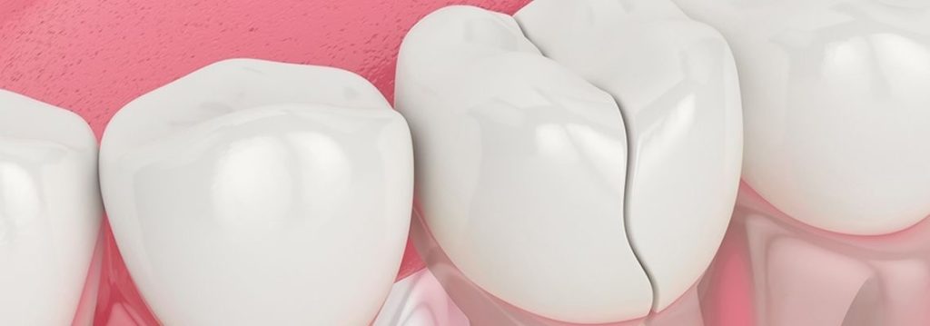 cracked teeth