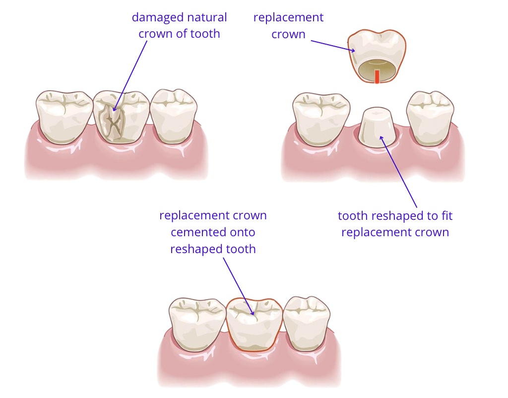 A schematic illustration of the crown placement procedure