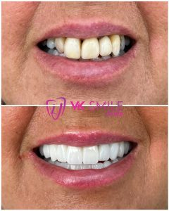 Dental crowns before after