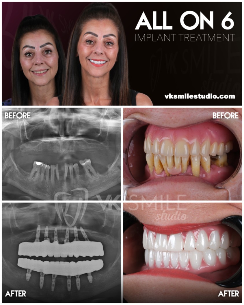 All-on-6 dental implants in Turkey
