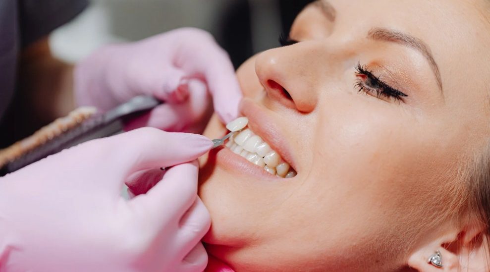Defining Laminate Veneers