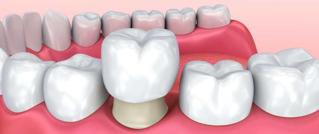 Dental Crowns