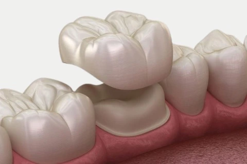 Dental Crowns