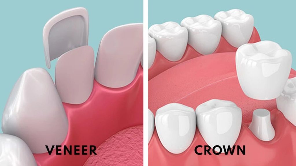 Dental Crowns and Veneers Differences