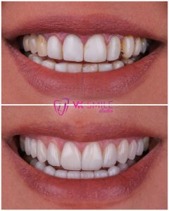 Dental crowns before after