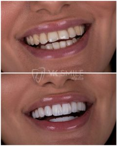 Dental crowns before after