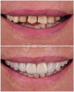 Dental crowns before after