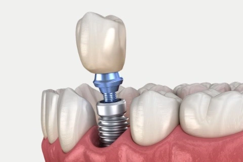 Dental Implants