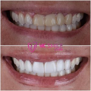 Dental implants before after