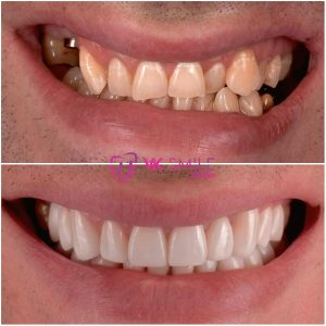 Dental implants before after