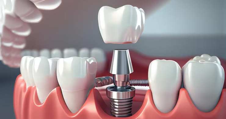 Dental Implants
