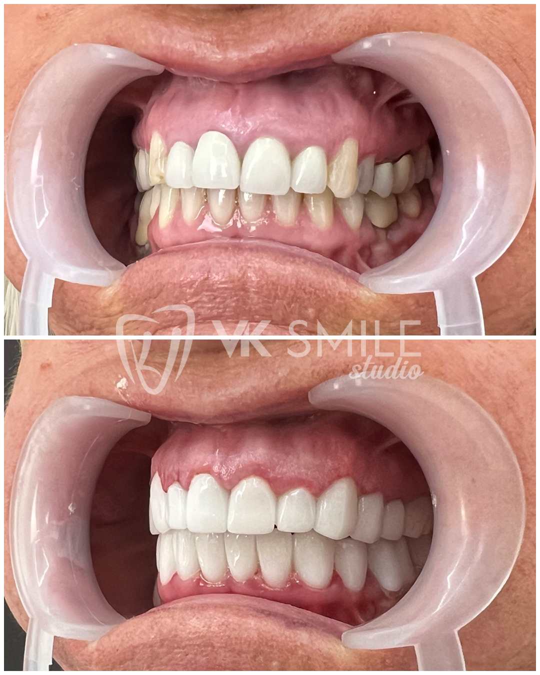 dental-veneers (1)