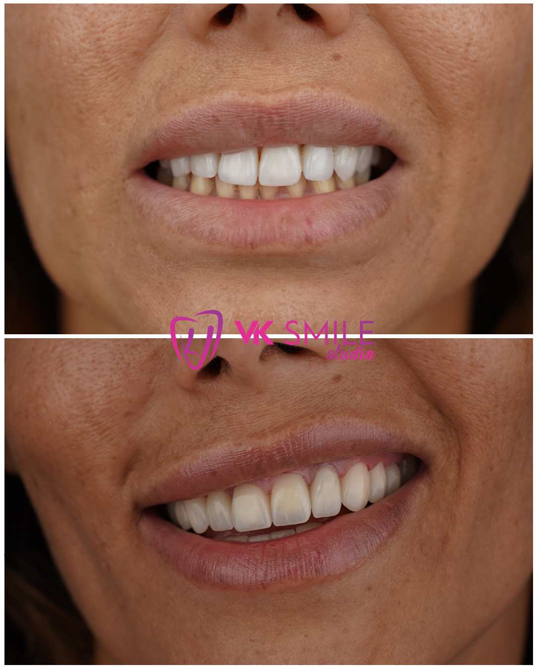 Dental Veneers