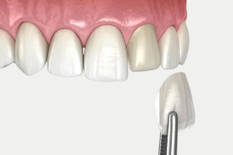Dental Veneers