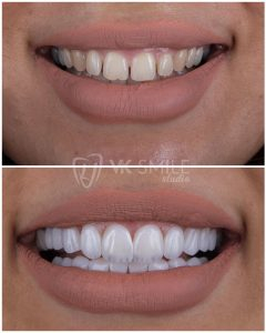 Dental veneers before after