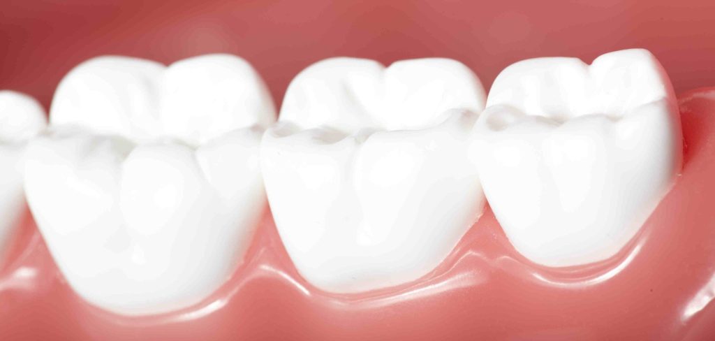 dental bridge
