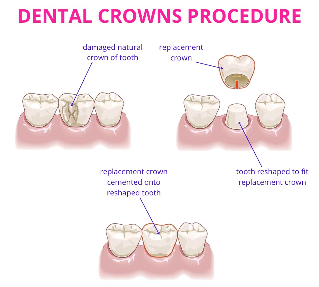 dental_crown_procedure