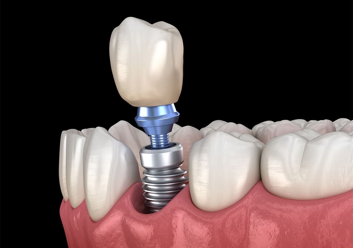 Dental implants treatment Turket