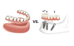 Implants vs. Dentures: Functions, Structure, and Costs