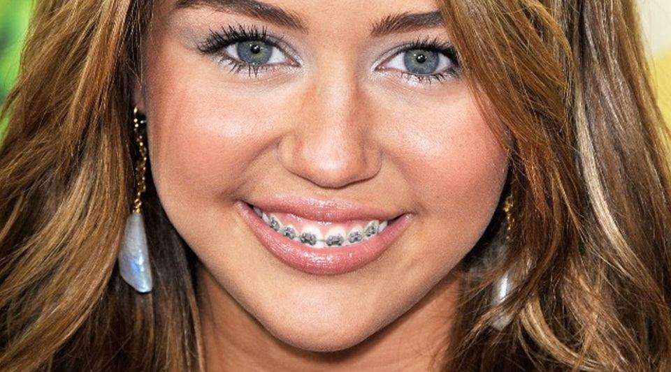 Did Miley Cyrus Use Dental Braces?