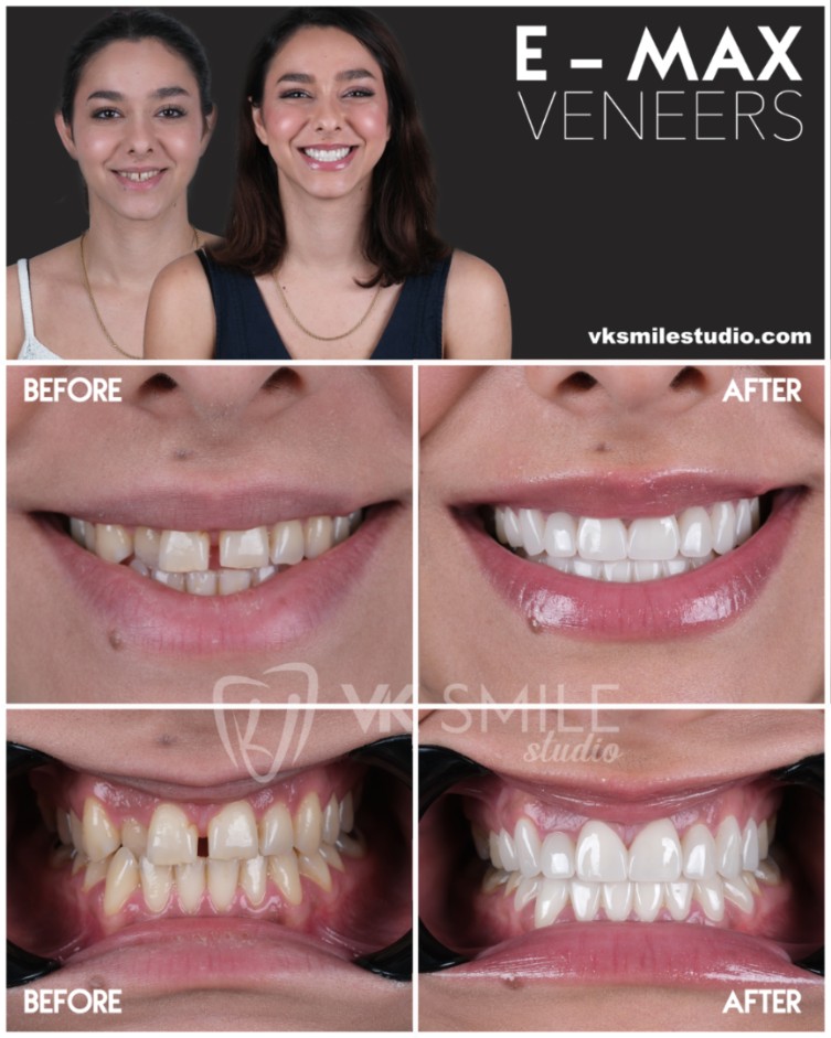 Veneers in Turkey