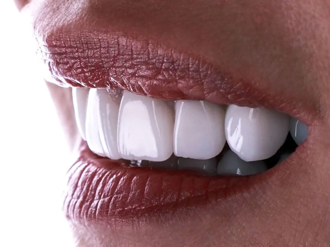 Emax Veneers in Turkey: Prices and Patient Reviews