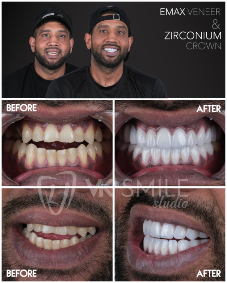 Zirconium crowns in Turkey