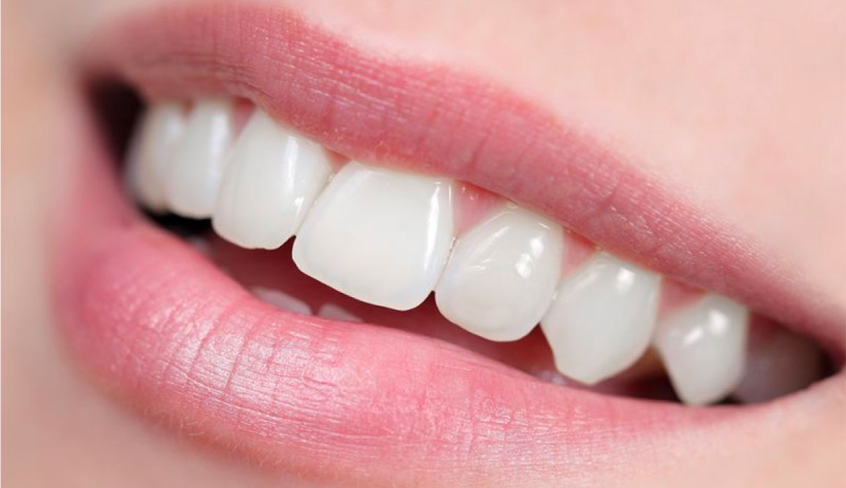 Emax Crowns in Turkey