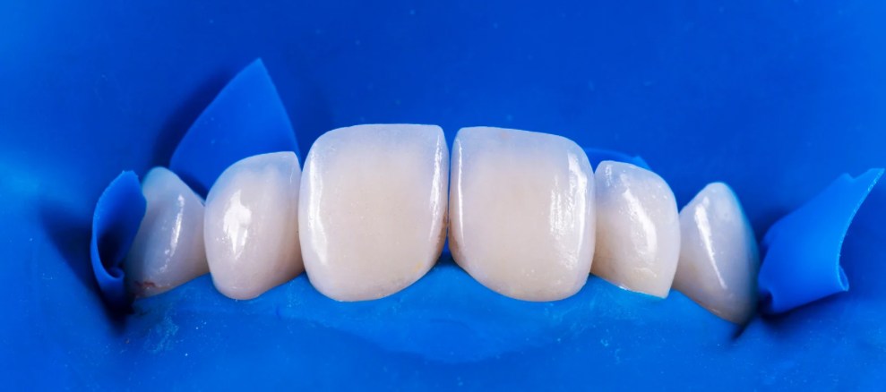 Emax Crowns Meaning
