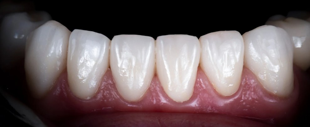 Defining Emax Veneers in Turkey