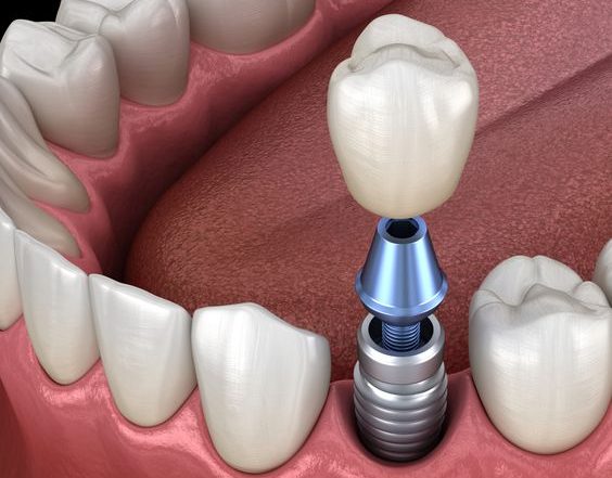 All on 6 dental implants