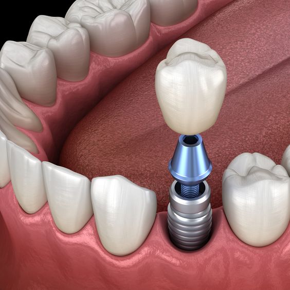 All on 6 dental implants
