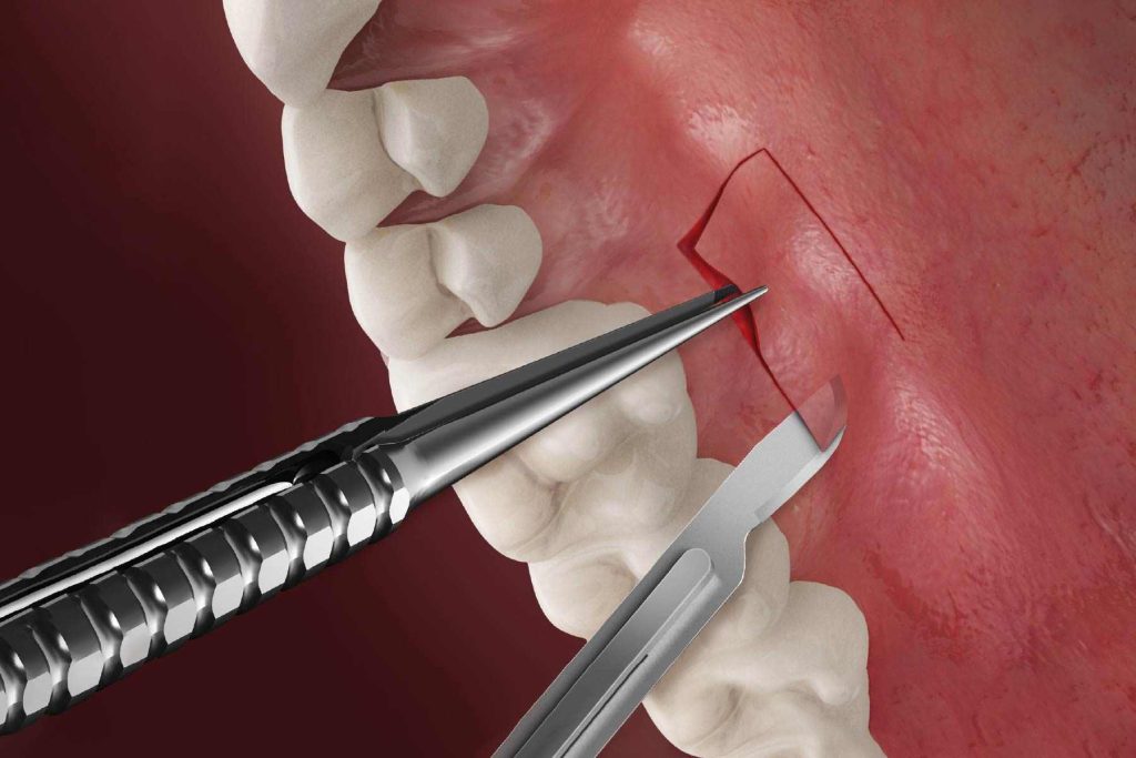 Free Gum Graft Surgery