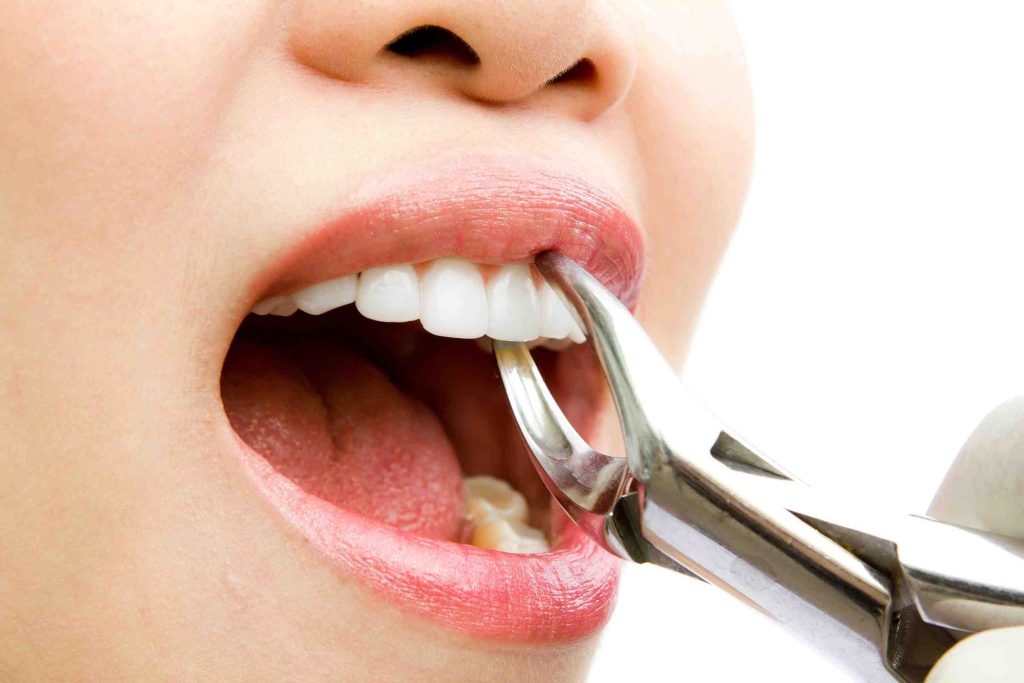 Front Teeth Removal