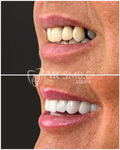 Dental crowns before after