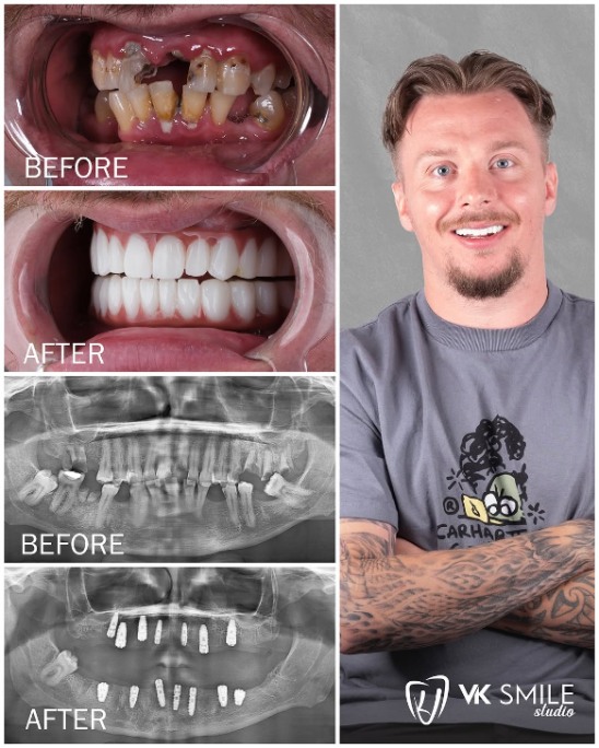 full mouth dental implants Turkey