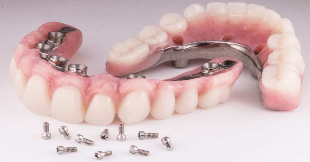 Full Mouth Dental Implants Turkey Prices
