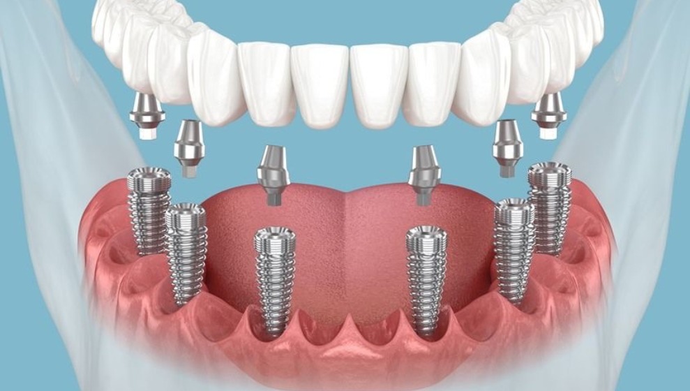 full mouth dental implants