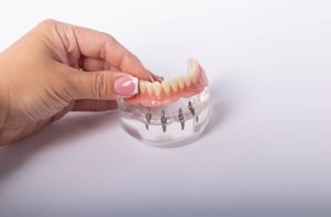 Full Set of Teeth Implants in Turkey