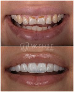 Dental veneers before after