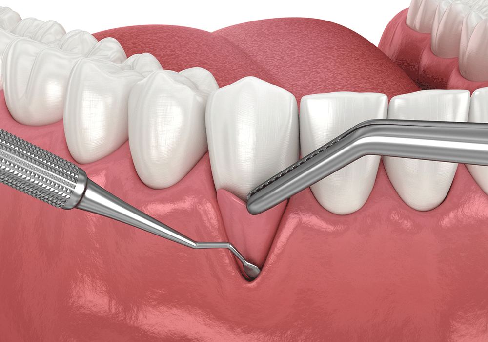 Gum Graft Surgery in Turkey