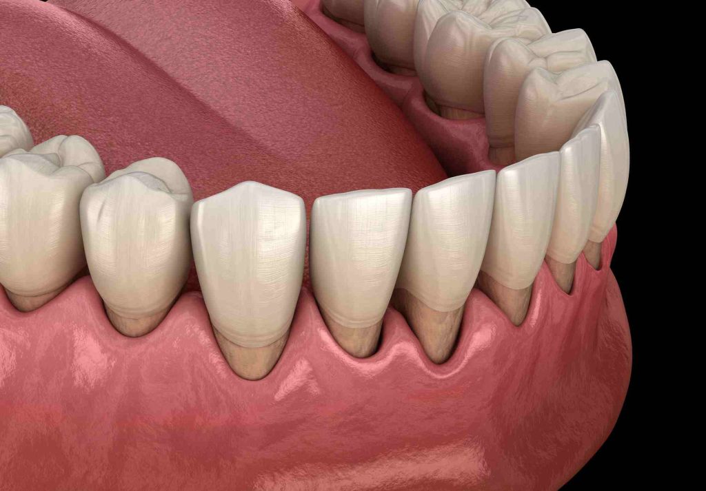 Gum Graft Treatment