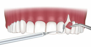 Gum Recession Treatment