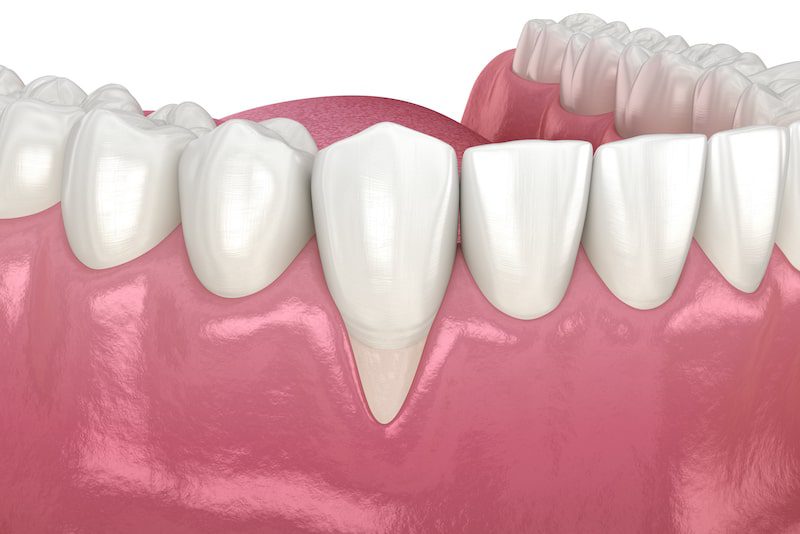 Gum recession
