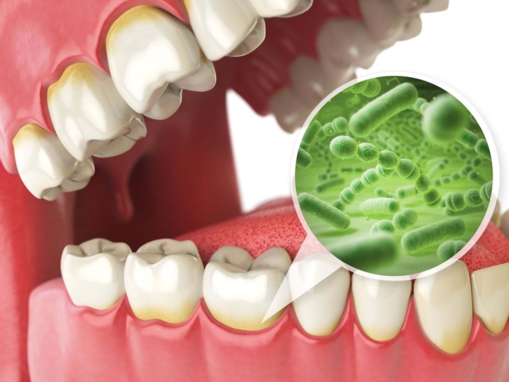 Bad Breath (Halitosis) Causes, Prevention, and Treatment in Turkey