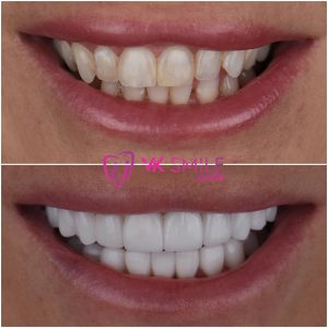 Hollywood smile before after