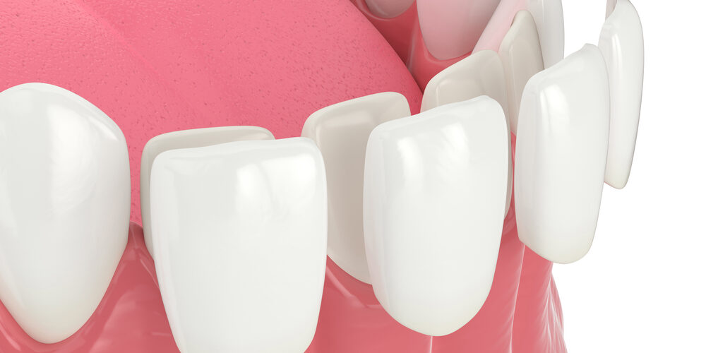How Much Does It Cost to Get Full Set of Veneers in Turkey?