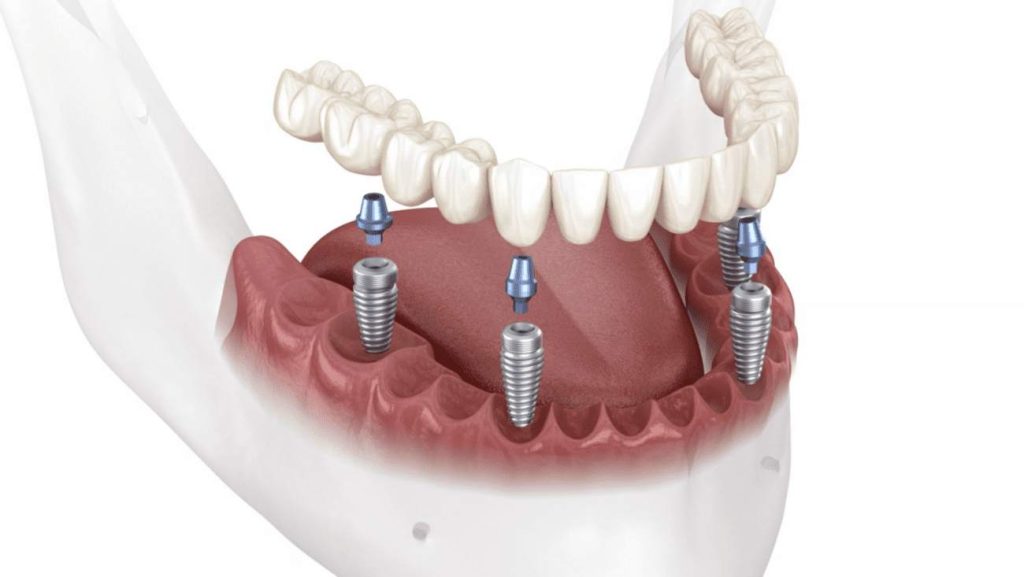 How Much Would a Full Mouth of Dental Implants Cost in Turkey?