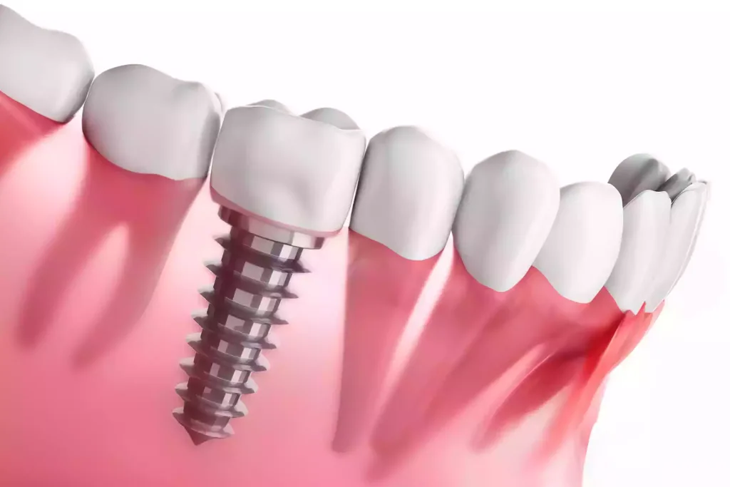 Immediate Dental Implantation in Turkey