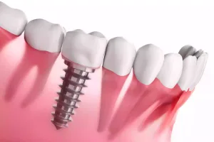Immediate Dental Implantation in Turkey